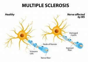 Treating Spine Pain Multiple Sclerosis MS