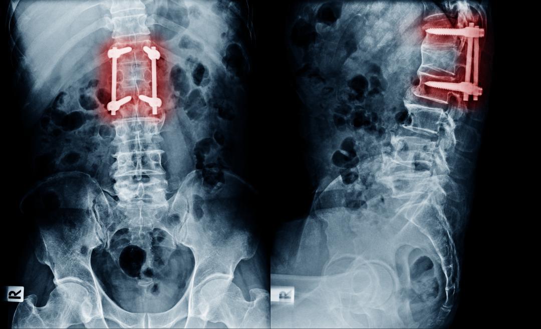X Ray Image Of Lumbar Spine Postoperative Treatment For Degenerative Lumbar Disc Disease By