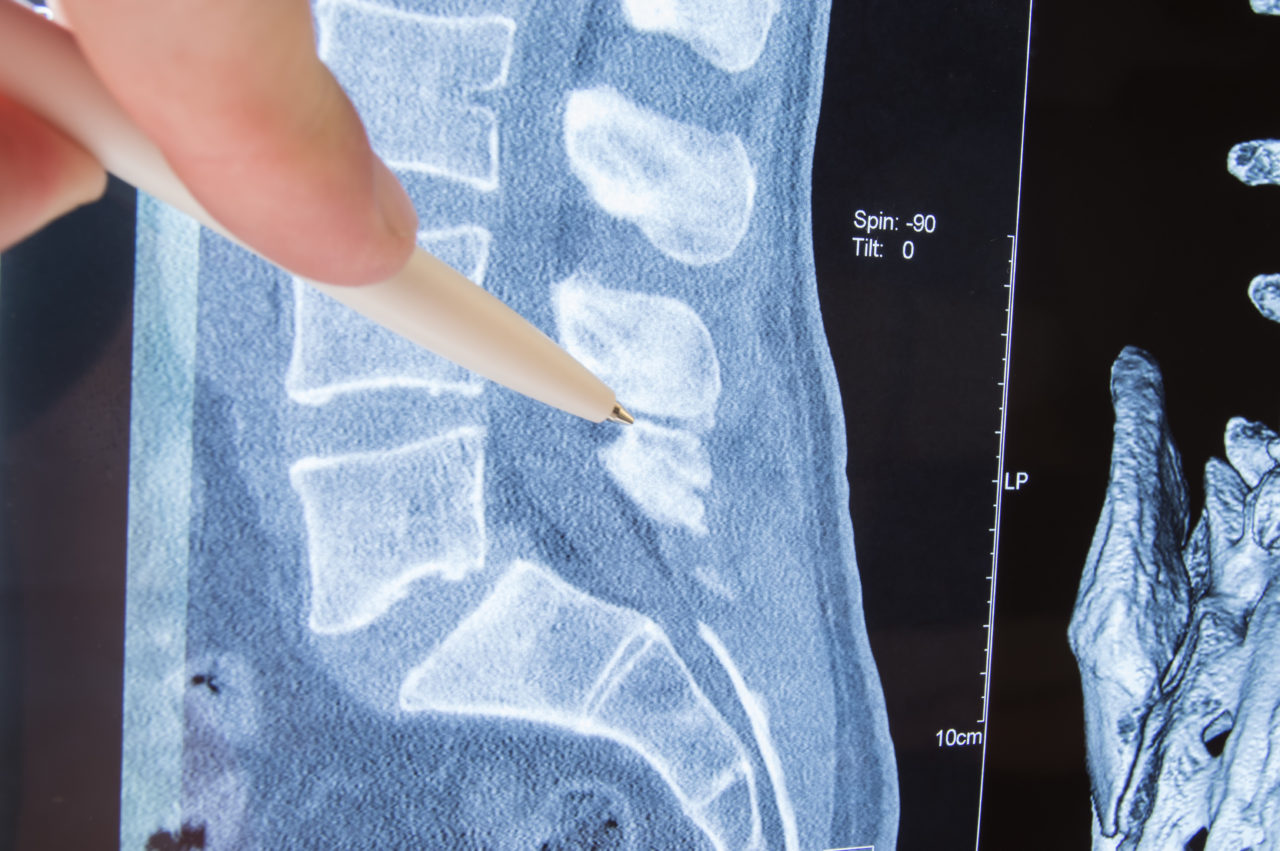 Surgical Treatments - Frisco Spine